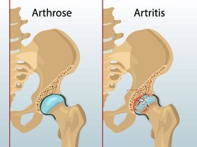 gelenkschmerzen bei arthrose und artritis
